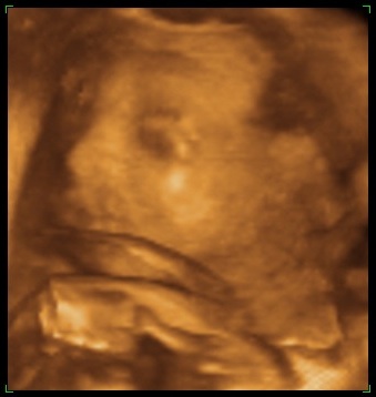 3d ultrasound pictures of twins. Tagged: 3D ultrasound, baby a,